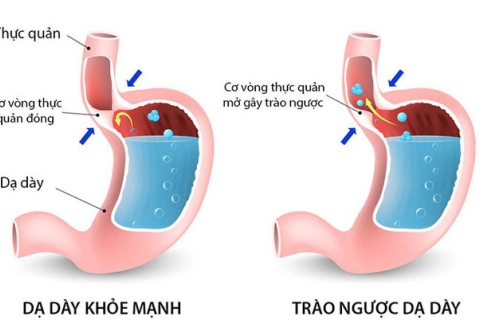 Bệnh trào ngược dạ dày thực quản: những vấn đề chung